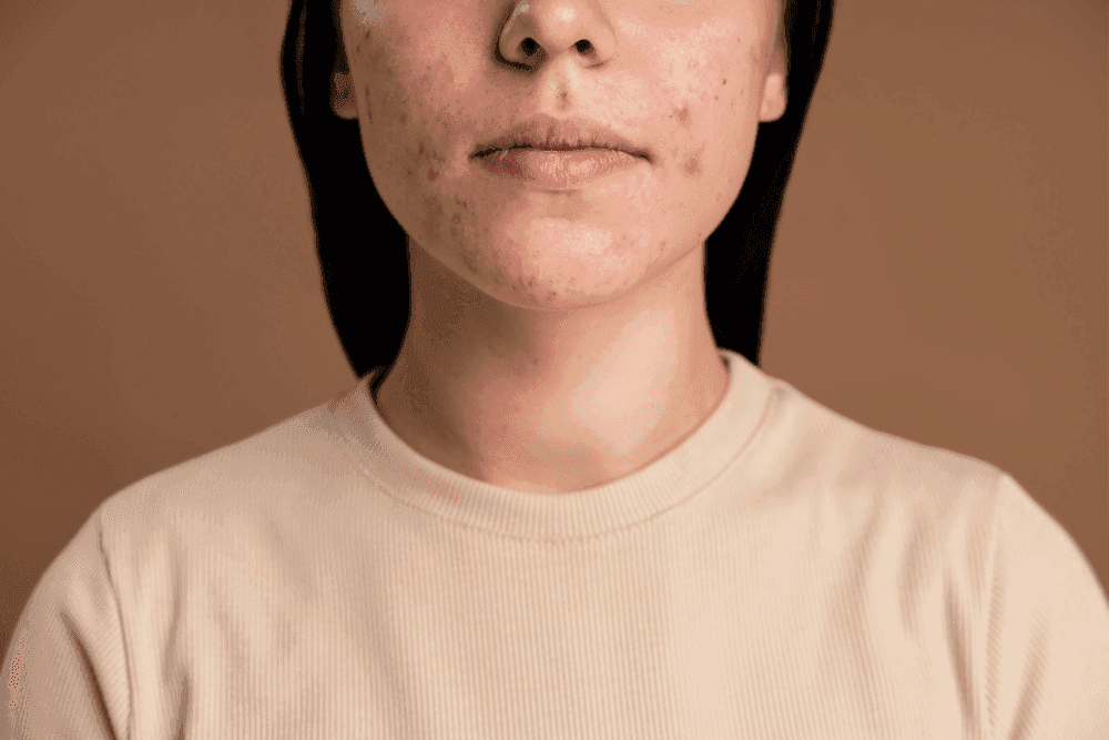 Imagem ilustrativa: Acne e oleosidade: tratamento certo para pele livre