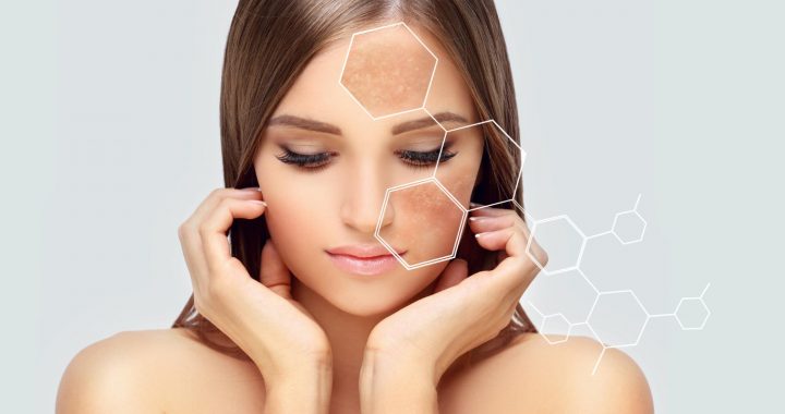 Melasma: o que é, por que aparece e como cuidar do seu jeito