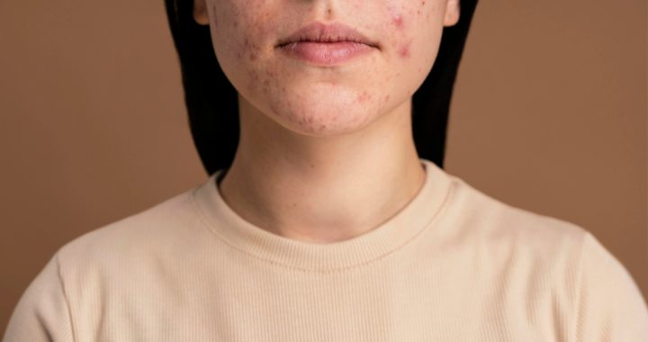 Acne e oleosidade: tratamento certo para pele livre